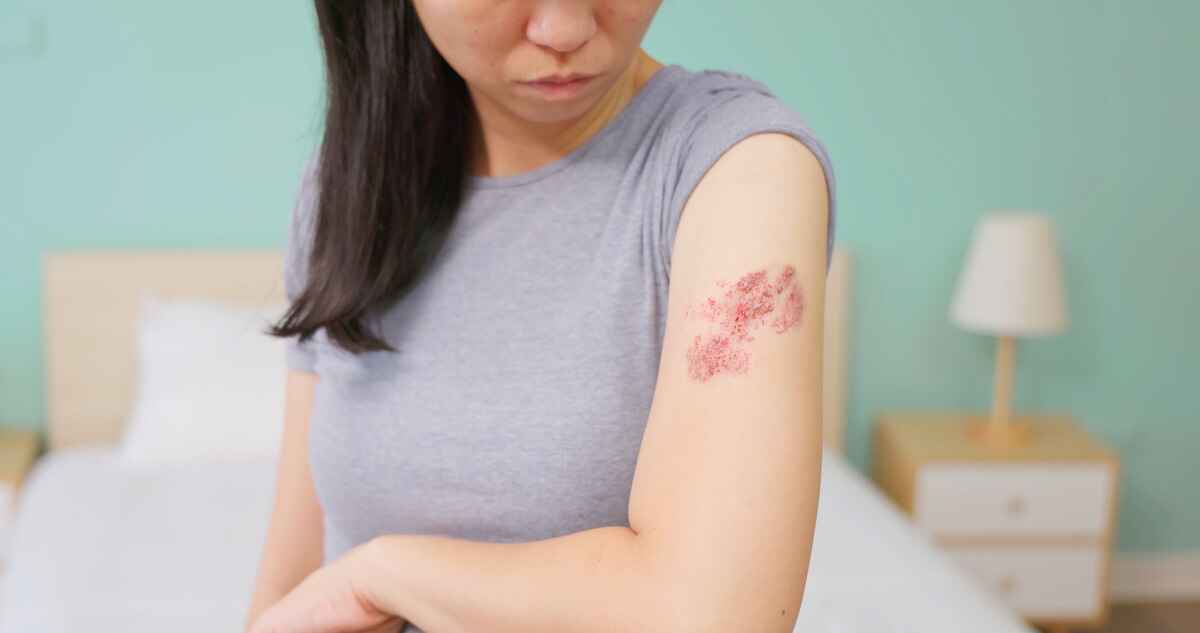 Woman with shingles rash on her arm
